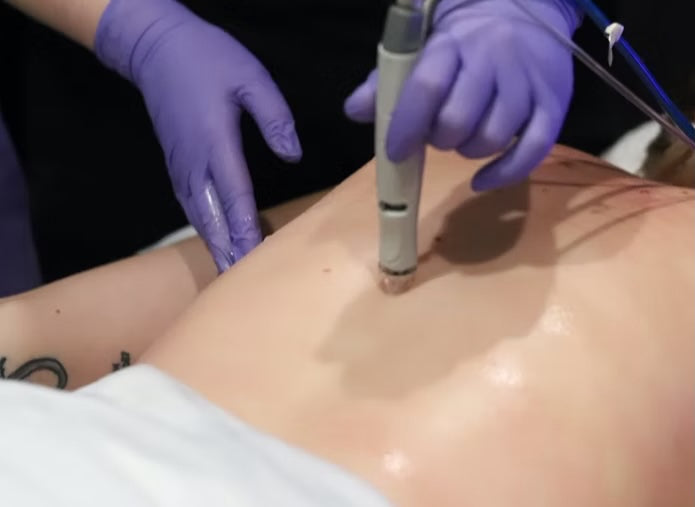 All About Back Treatments: Treat the Often-Ignored Skin This Season