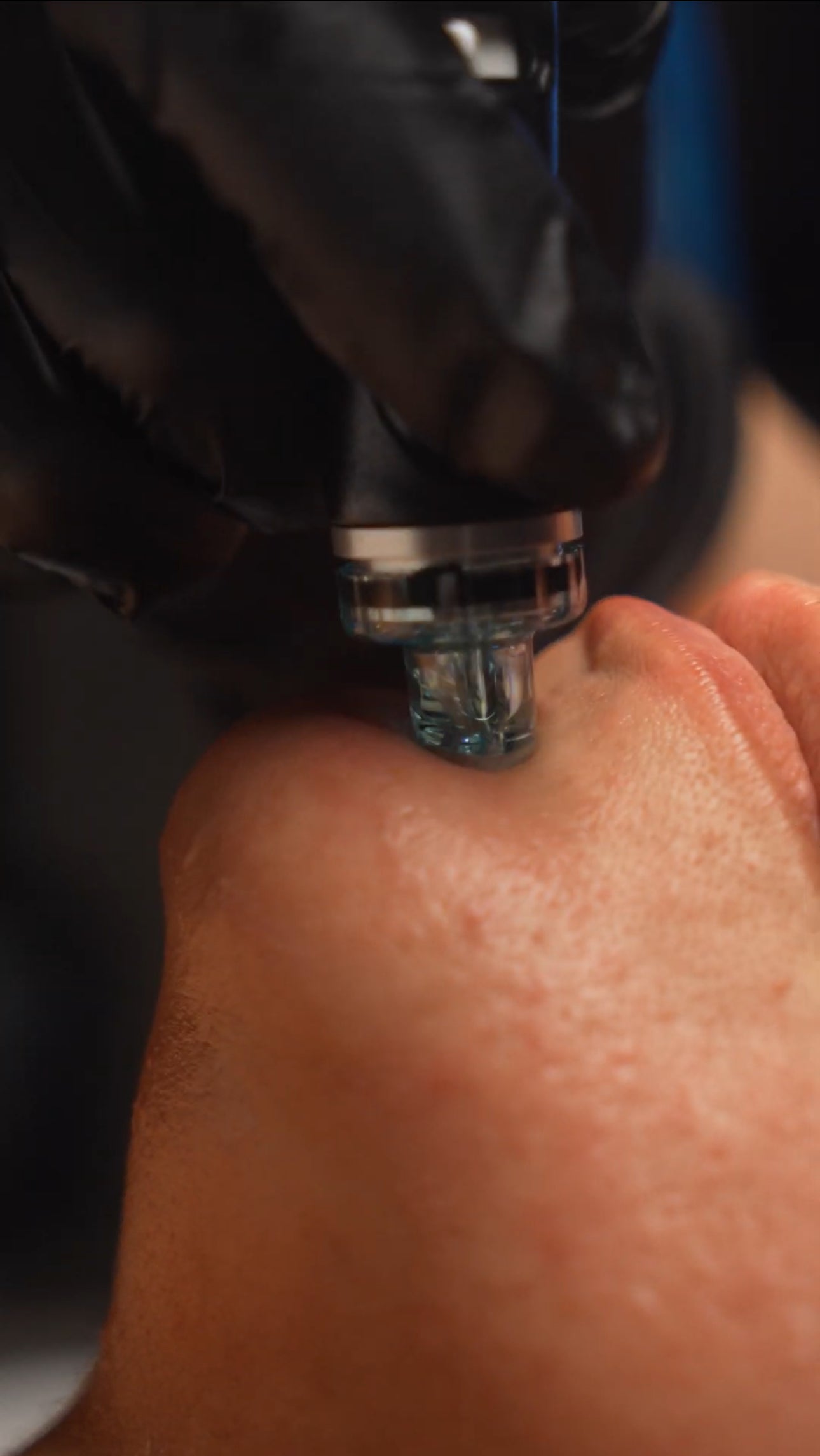 Restore Your Glow: Why Hydrafacial® Is the End-of-Summer Skin Rescue